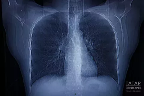 Туберкулезга каршы – бергәләп!